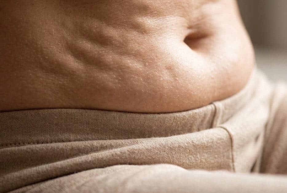 Skóra z widoczną „pikowaną” strukturą cellulitu